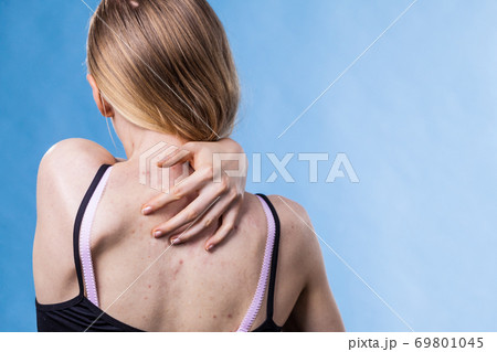 Woman with skin problem acne on back 69801045