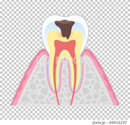 箍牙 牙齒 齒輪 69818297