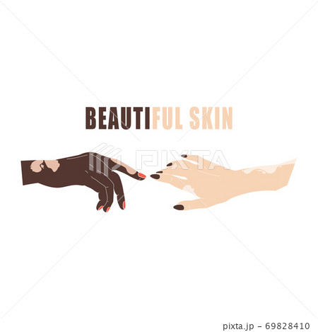 Hands with age spots or vitiligo. Hand gestures with genetic skin disease.  69828410