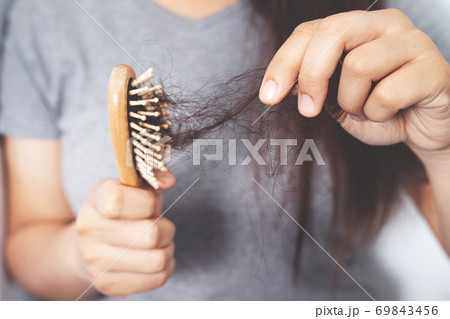 Women with hair loss Because she is allergic to shampoo Women with hair loss Because she is allergic to shampoo 69843456
