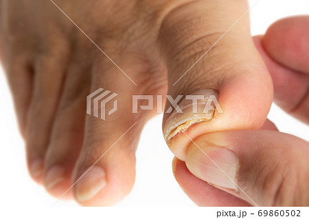 足の指の爪水虫 足の指の爪水虫 69860502