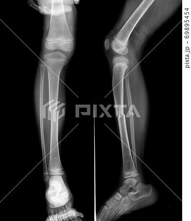 Radiography of Tibial fracture at mid shaft of the bone in young boy patient.	 69895454