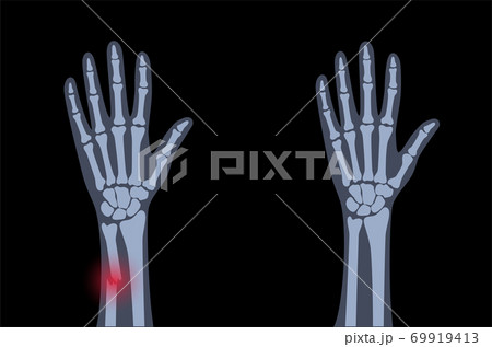 Fracture x ray concept Fracture x ray concept 69919413