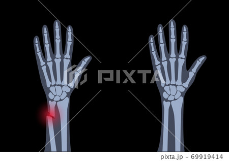 Fracture x ray concept Fracture x ray concept 69919414