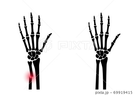 Fracture x ray concept Fracture x ray concept 69919415