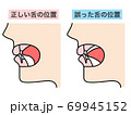 正しい舌の位置 誤った舌の位置 69945152