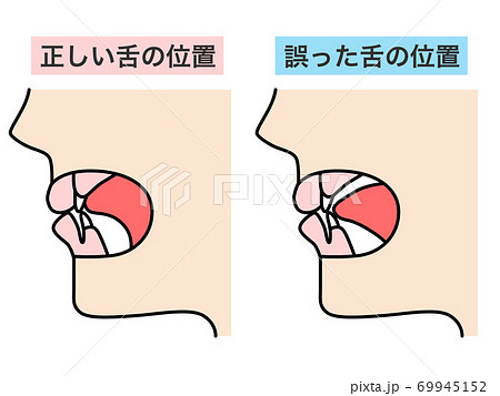 正しい舌の位置 誤った舌の位置のイラスト素材