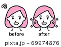 ホワイトニング ビフォーアフター（女性） 69974876