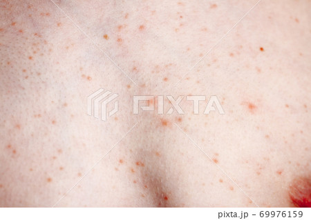 Close up image of a little boy's body suffering severe urticaria, nettle rash also called hives Close up image of a little boy's body suffering severe urticaria, nettle rash also called hives 69976159