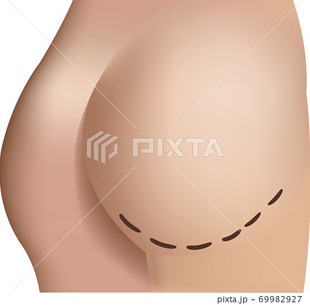 image of a female butt with face lift marks 69982927
