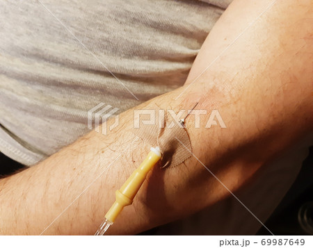 Close-up photo of a male hand with a dropper inserted into a vein Close-up photo of a male hand with a dropper inserted into a vein 69987649