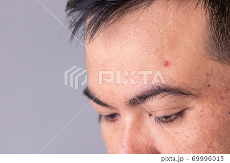 Face skin of asian man to show many skin problem. Men skin care concept on grey space background 69996015