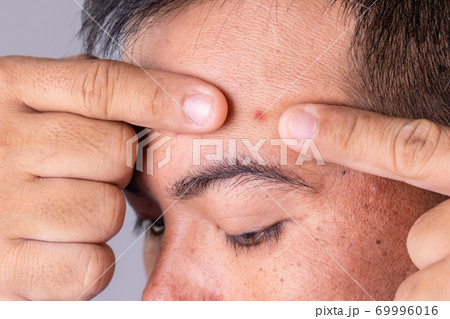 Face skin of asian man to show many skin problem. Men skin care concept on grey space background Face skin of asian man to show many skin problem. Men skin care concept on grey space background 69996016