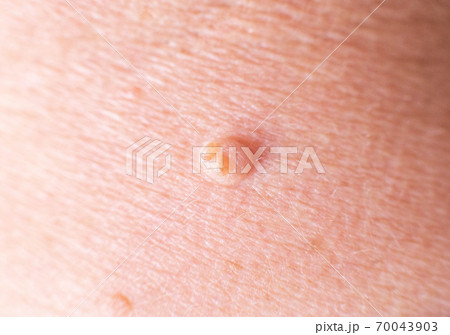 large wart on the skin of a person, background, macro, dermatology 70043903