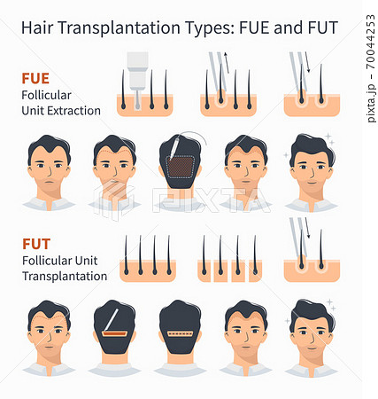 Types Of Hair Transplantation Fue And Futのイラスト素材
