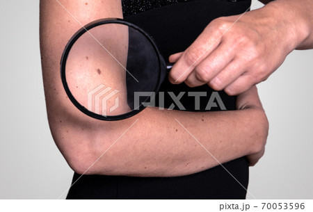 Birthmark and magnifying glass. Skin health and beauty. Research and medicine Birthmark and magnifying glass. Skin health and beauty. Research and medicine 70053596