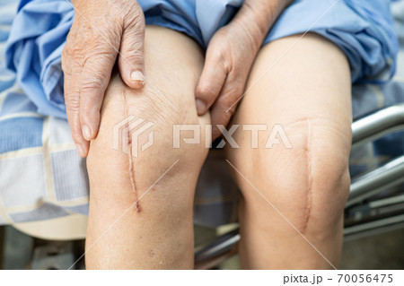 Asian senior or elderly old lady woman patient show her scars surgical total knee joint replacement Suture wound surgery arthroplasty on bed in nursing hospital ward, healthy strong medical concept. 70056475