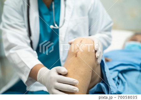 Asian senior or elderly old lady woman patient show her scars surgical total knee joint replacement Suture wound surgery arthroplasty on bed in nursing hospital ward Asian senior or elderly old lady woman patient show her scars surgical total knee joint replacement Suture wound surgery arthroplasty on bed in nursing hospital ward 70058035