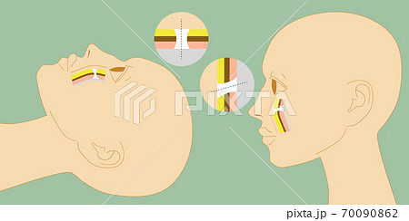 フェイスリフト説明図 リガメント Smasのイラスト素材