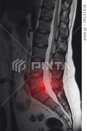 Image after examination of magnetic resonance imaging. Spine examination concept, otseochondrosis, lumbar intervertebral hernia, inflammation 70131416