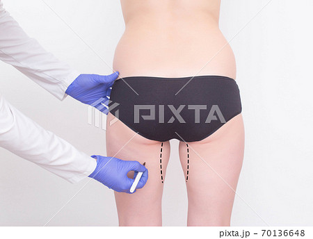 Doctor plastic surgeon makes a marker marker for plastic surgery on the hips of a girl. The concept of removing excess fat on the legs from the inside of the thigh, background, cruroplasty Doctor plastic surgeon makes a marker marker for plastic surgery on the hips of a girl. The concept of removing excess fat on the legs from the inside of the thigh, background, cruroplasty 70136648