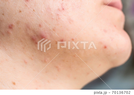 Red acne and a rash on a girl's face and neck, macro, hormone 70136702