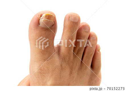 爪水虫で割れた男の足の親指の爪の写真素材
