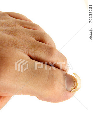 爪水虫で割れた男の足の親指の爪の写真素材