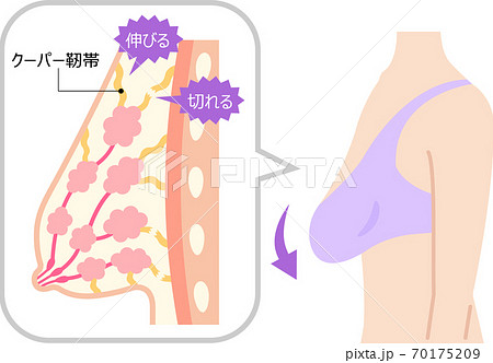 Drooping breast Cooper's ligament female body - Stock Illustration  [70175209] - PIXTA