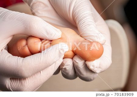 Doctor little girl's foot with fungus infection 70183909