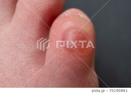 Callus on pinky toe after wearing uncomfortable shoes. Close up view. Callus on pinky toe after wearing uncomfortable shoes. Close up view. 70190861