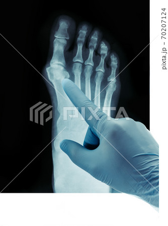 X-ray of the feet valgus deformity of the toe or a bone on a finger 70207124