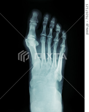 X-ray of the feet valgus deformity of the toe or a bone on a finger 70207125