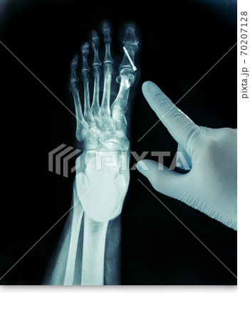 X-ray of the front foot after Hallux Valgus surgery blue gloves X-ray of the front foot after Hallux Valgus surgery blue gloves 70207128