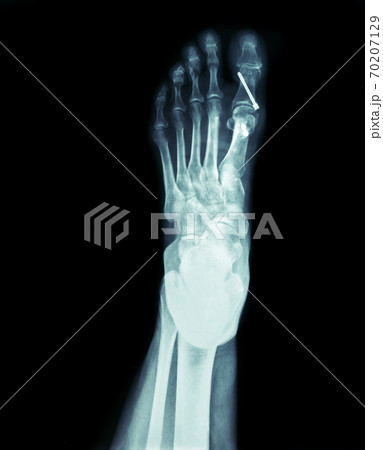 X-ray of the front foot Hallux Valgus surgery 70207129