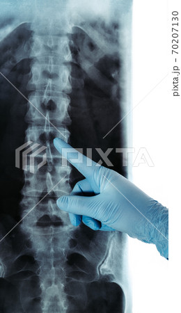 X-ray of lumbar spine classical radiology RTG blue glove pointed 70207130