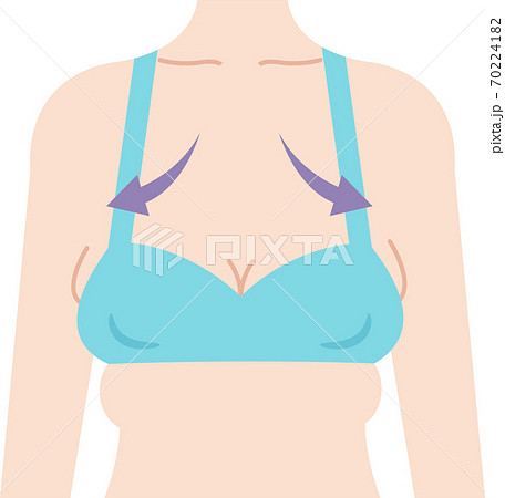 離れ乳 女性 ビフォアアフター 離れ乳 女性 ビフォアアフター 70224182