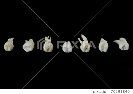 Torn diseased human teeth stacked in a row isolated on black background. Close-up photo of spoiled molars and premolars. Torn diseased human teeth stacked in a row isolated on black background. Close-up photo of spoiled molars and premolars. 70291840