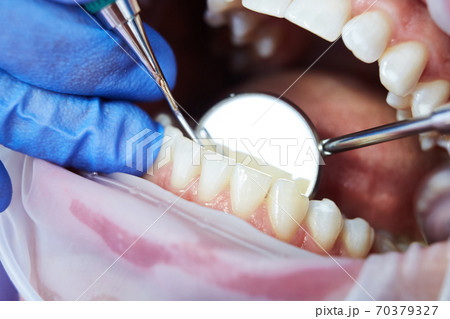 Close-up of woman opening his mouth wide during inspection of oral cavity. Shallow dof Close-up of woman opening his mouth wide during inspection of oral cavity. Shallow dof 70379327