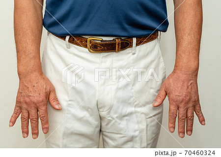 ゴルファー　グローブを着けない右手の日焼けシミ 70460324