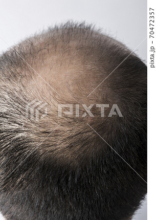 薄毛の男性 薄毛の男性 70472357