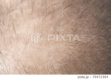 薄毛の男性 薄毛の男性 70472364