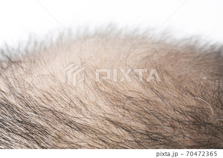 薄毛の男性 70472365