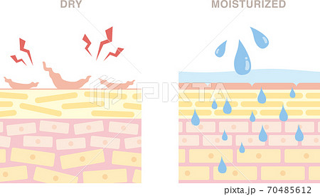 乾燥肌と潤った肌の断面図 明るい色合いの かわいいイラスト のイラスト素材
