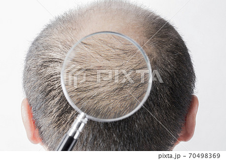 薄毛の男性 70498369