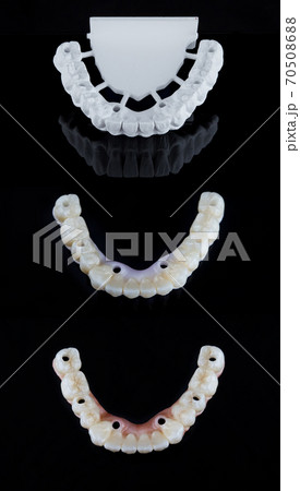 Three stages of making full dental cirkonium prosthesis on implants. Dental care concept. Three stages of making full dental cirkonium prosthesis on implants. Dental care concept. 70508688