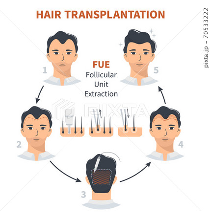 Stages of hair transplantation FUE Unit Extraction 70533222