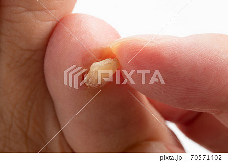 剥がれかけた足の小指の爪 70571402