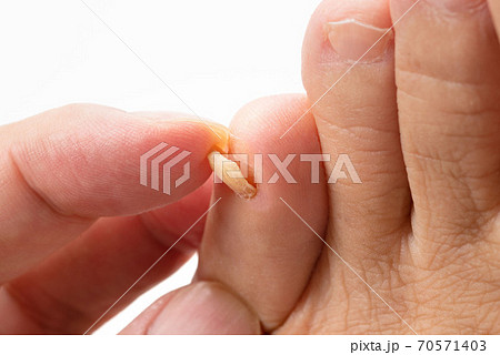 剥がれかけた足の小指の爪の写真素材
