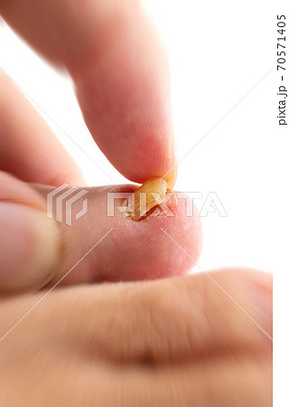剥がれかけた足の小指の爪の写真素材